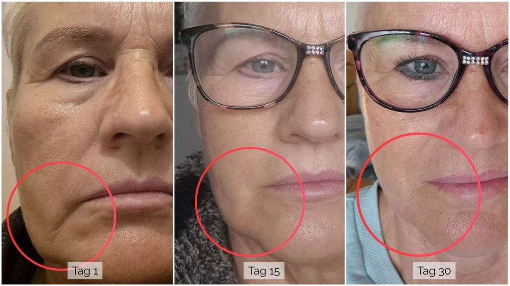 Gesichtscreme für trockene Haut: Nahaufnahme der linken Wange und Mundpartie mit Brille; roter Kreis markiert die Mundfalte; Label ‚Tag 30‘