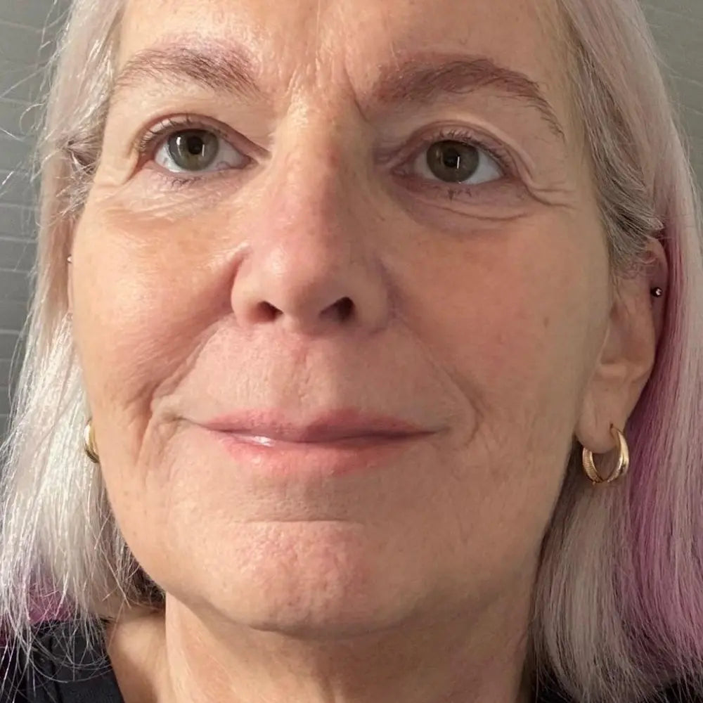 Vorher Foto Petra bauer, Pliseefältchen und schuppige trockene Haut