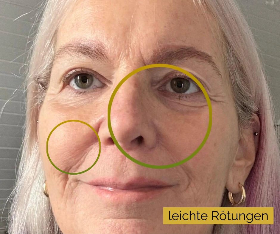 trockene schuppige haut im gesicht erfahrungsbericht petra 57