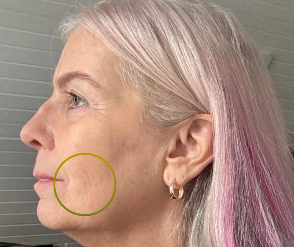 Petra mit plissefältchen und trockener, schuppiger Haut vorher foto