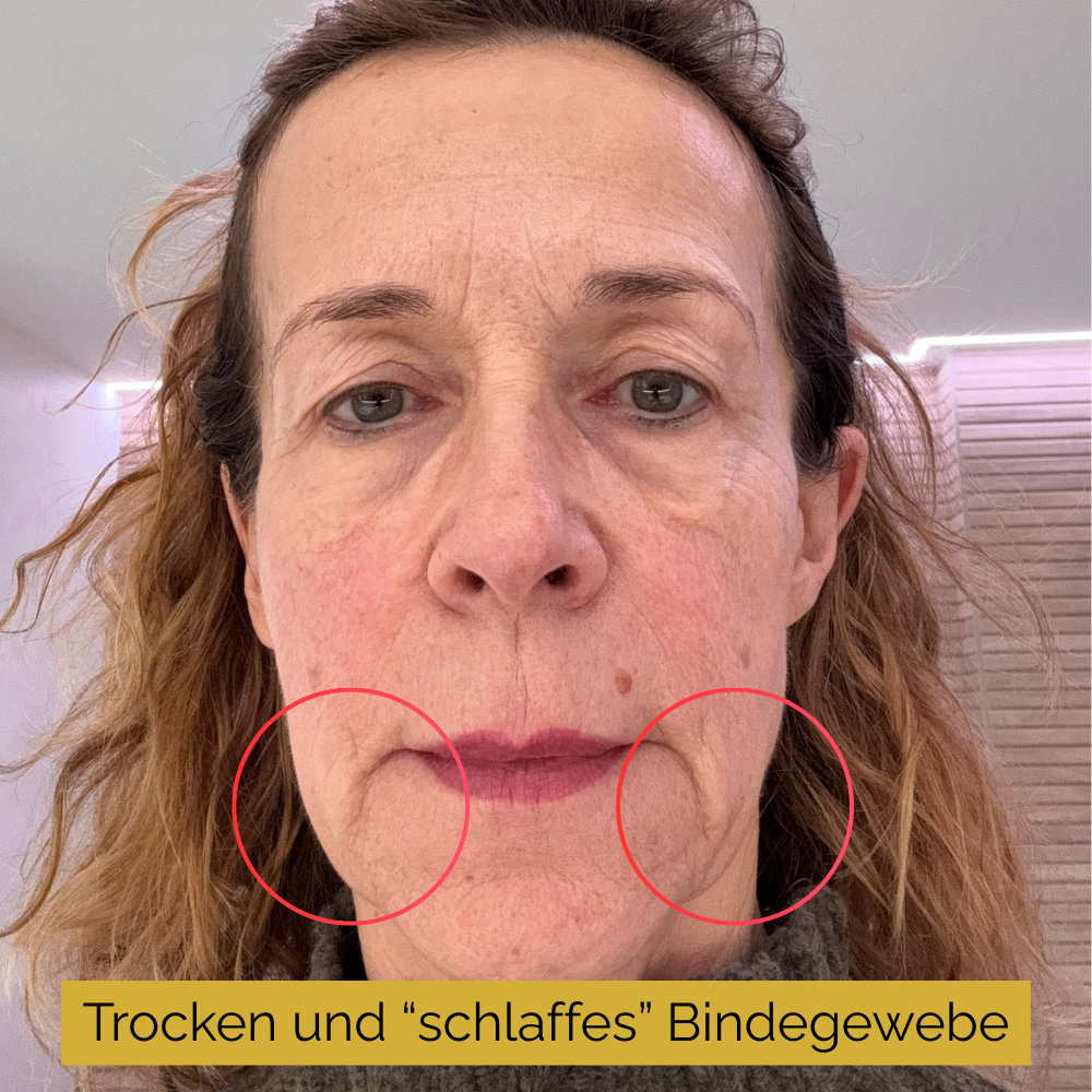 Frontaufnahme: trockene, gereizte Gesichtshaut mit Spannungsgefühl; markierte Bereiche um Mund/Kinn zeigen Trockenheit und wenig pralles Hautbild.“