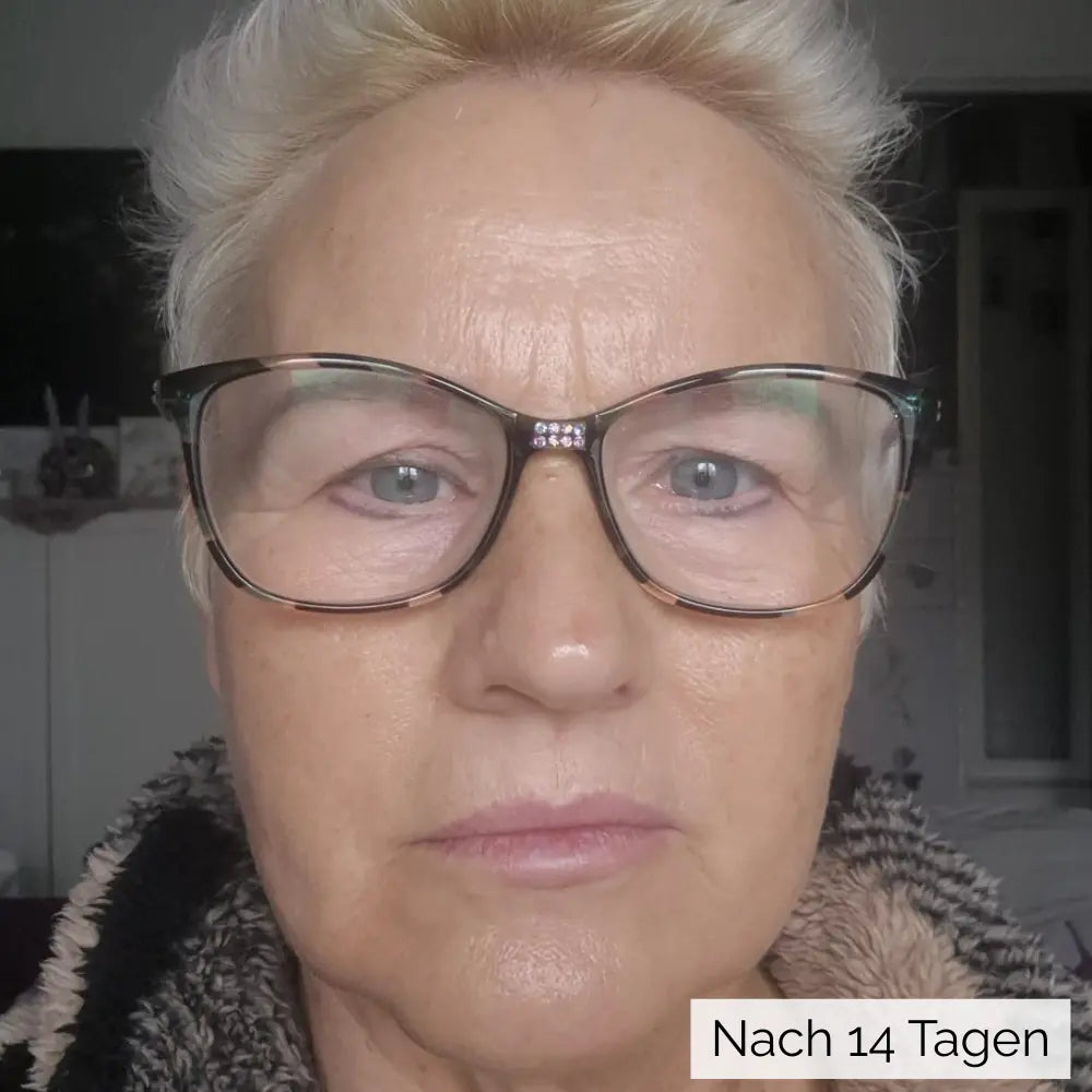 Nahaufnahme der linken Wange und Mundpartie mit Brille, Linien wirken weicher; roter Kreis markiert den Bereich, Label ‚Tag 15‘