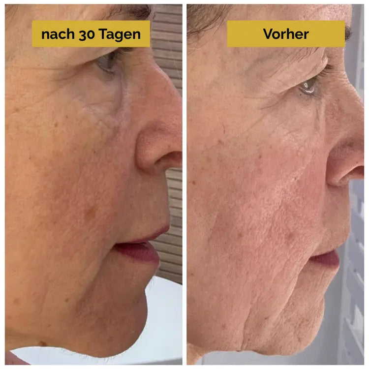 21-Tage-Poren-Kit - Hyluna