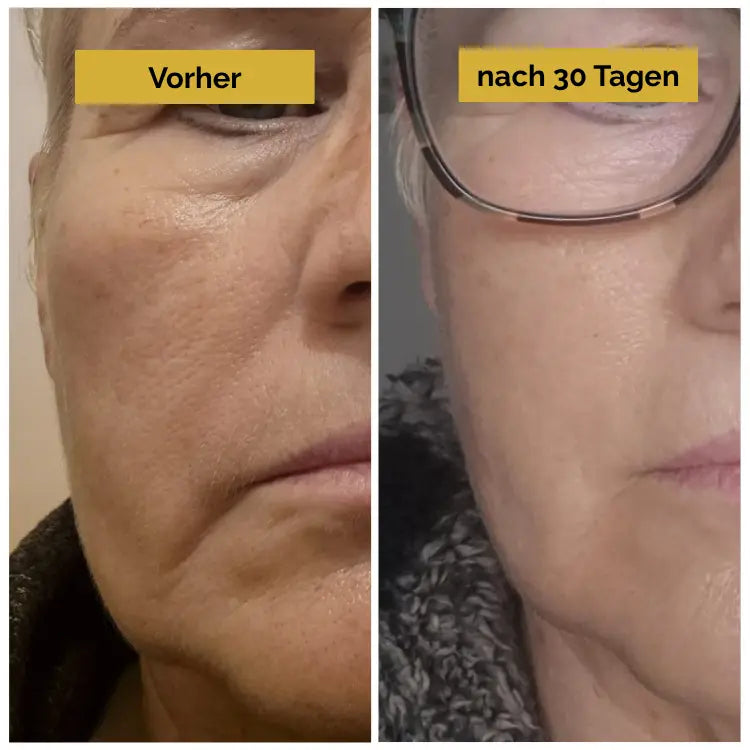 21-Tage-Poren-Kit - Hyluna