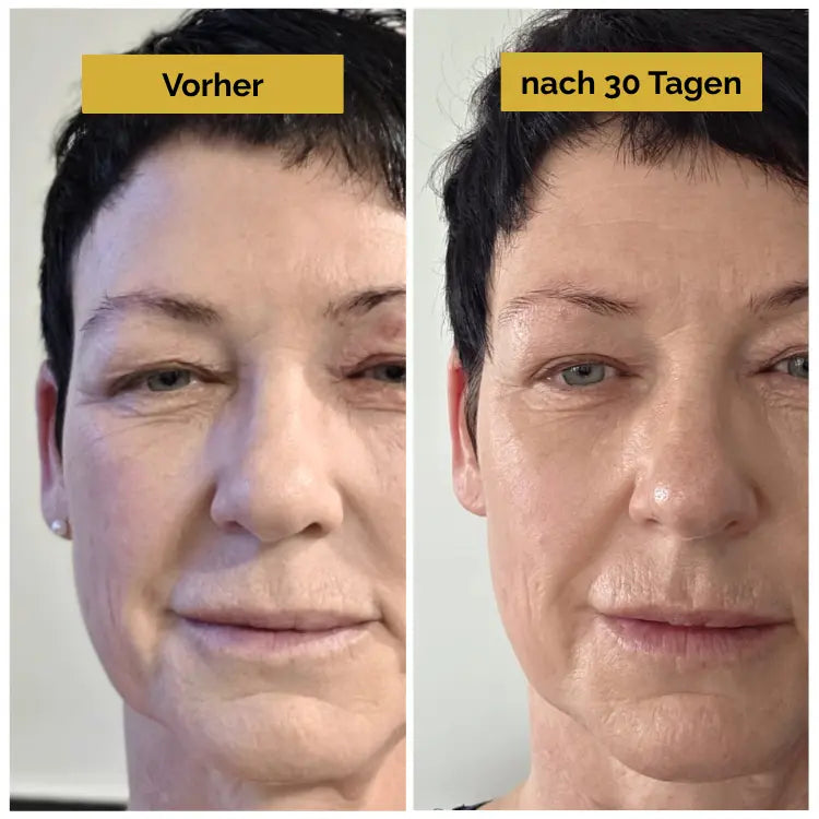 21-Tage-Poren-Kit - Hyluna